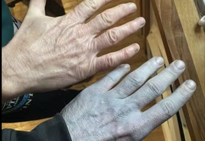 Ra në gjumë shëndosh e mirë, zgjohet i gjithi blu, rasti qesharak në Britani